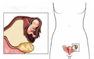 Эндометриоидная киста яичника: причины, симптомы, лечение