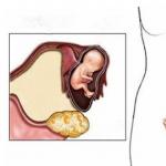 Эндометриоидная киста яичника: причины, симптомы, лечение